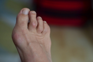 Choosing the Right Shoes for Hammertoes