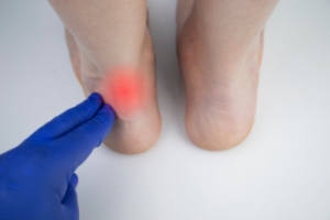 Protecting Your Achilles Tendon While Playing Pickleball